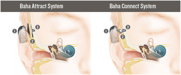 hearing-aids-hearing-loss-hearing-needs-hear-test-tinnitus-prices-sri-lanka