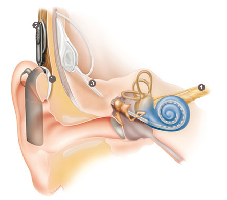 hearing-aids-hearing-loss-hearing-needs-hear-test-tinnitus-prices-sri-lanka